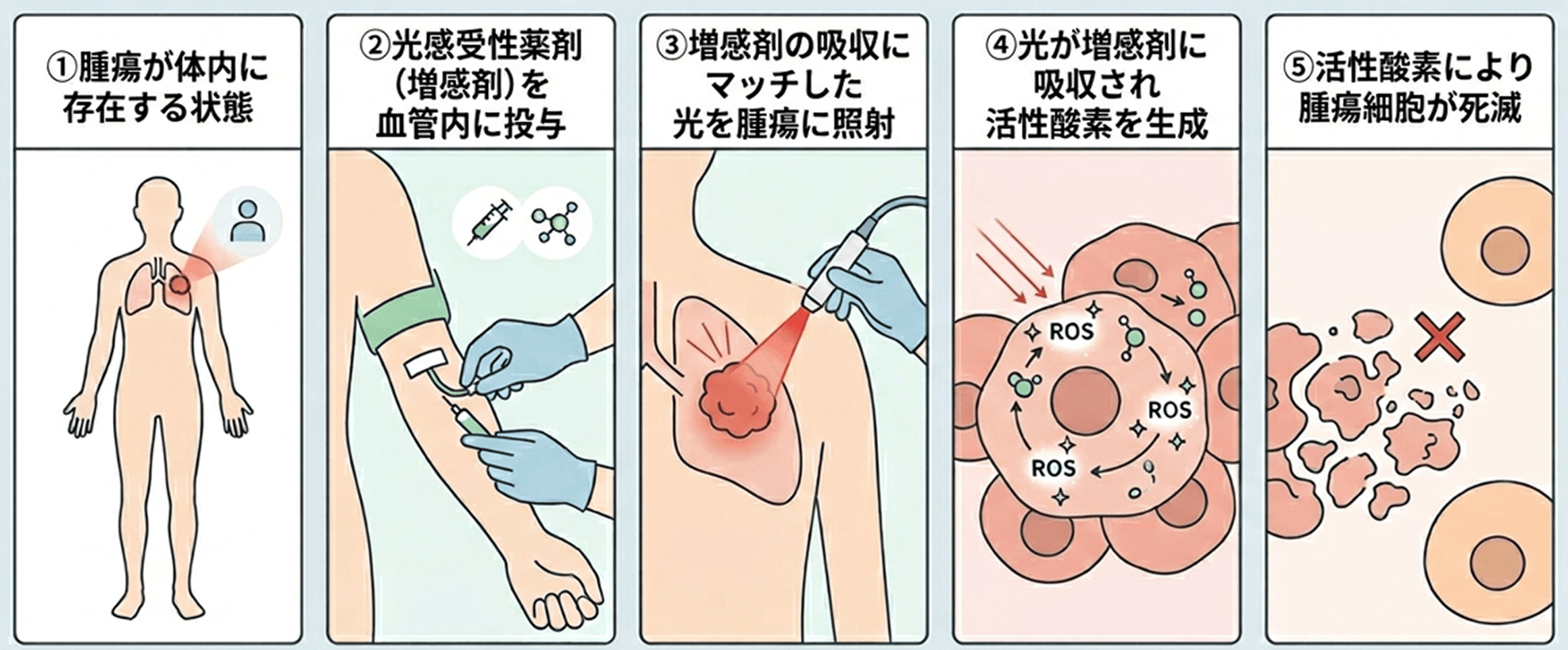光線力学療法（PDT）の仕組み