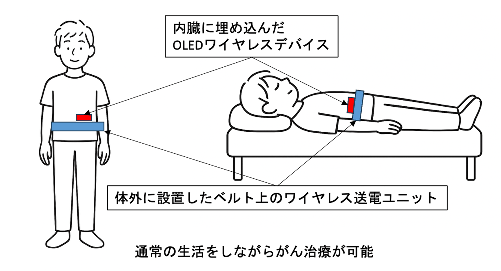 将来のmPDTを使用したがん治療のイメージ